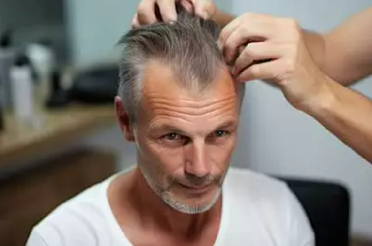 Does Low Testosterone Cause Hair Loss